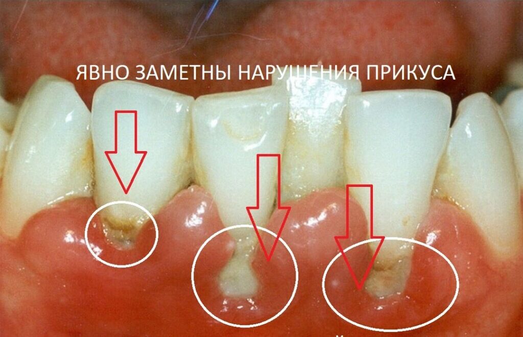 Гингивит