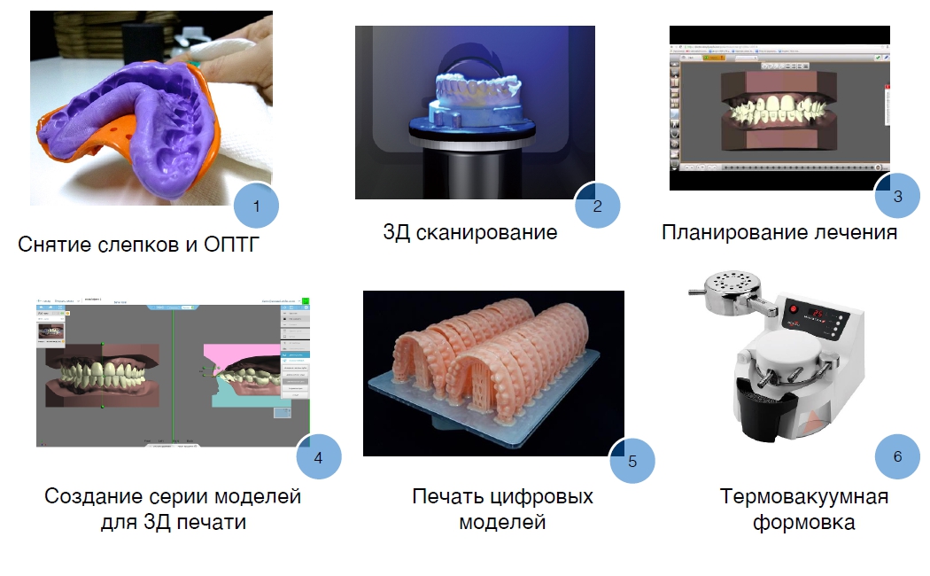 Как производят элайнеры